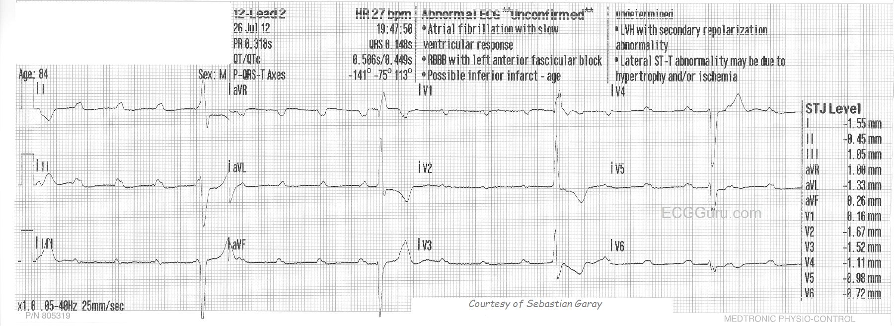 paroxysmal-ventricular-standstill-this-strip-shows-sr-with-3-beats-of